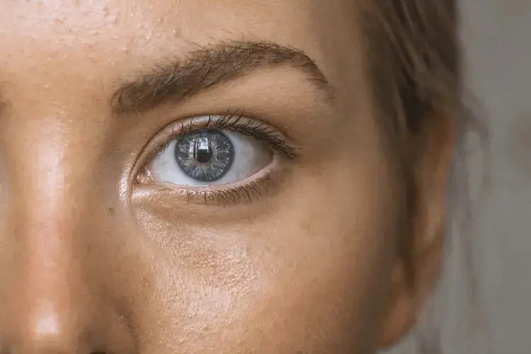 Everything You Need To Know About Acne Scars