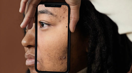 What Causes Acne Scars? How do I get rid of them?