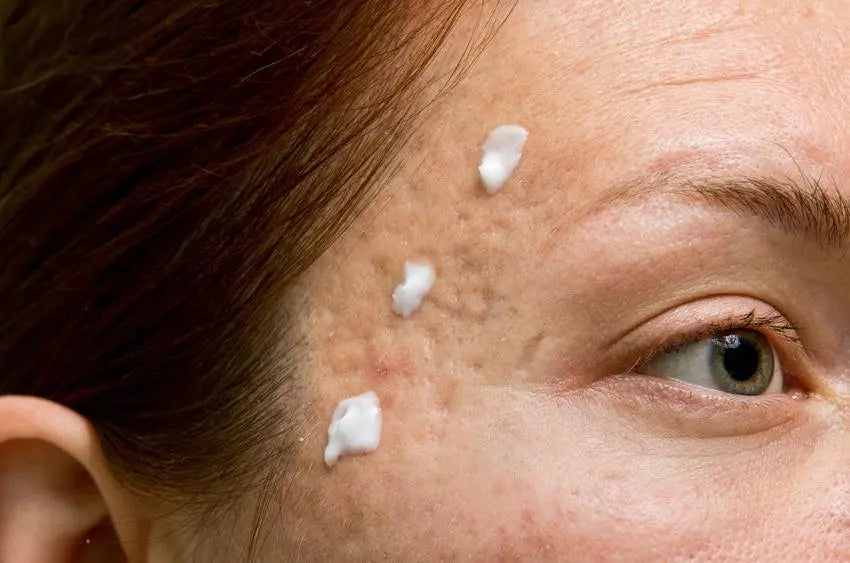 Acne Scars  How to Diminish the Appearance - Acne Intelligence